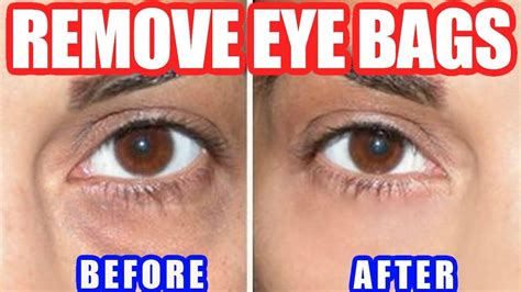 removal of bags under eyes